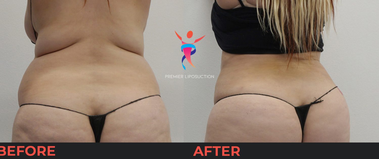 upper back and hip liposuction before and after