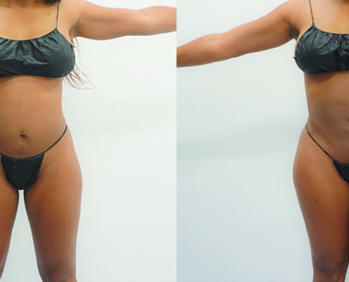 woman 360 liposuction before and after
