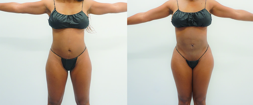 Before and After Liposuction Gallery | See the Results!