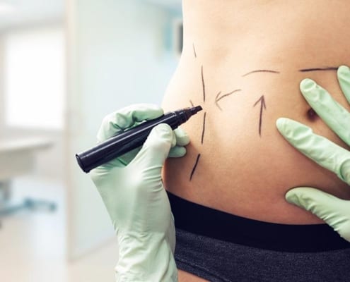 Liposuction for weight loss