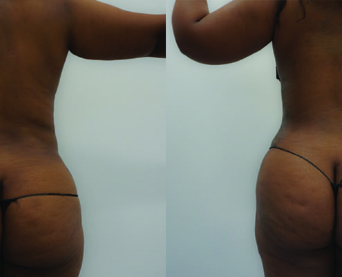 before and after woman hip roll liposuction