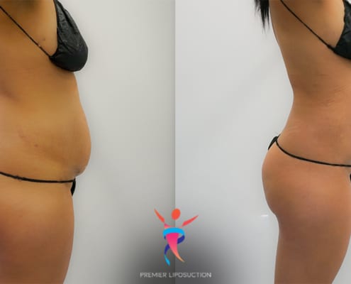 360 liposuction before & after