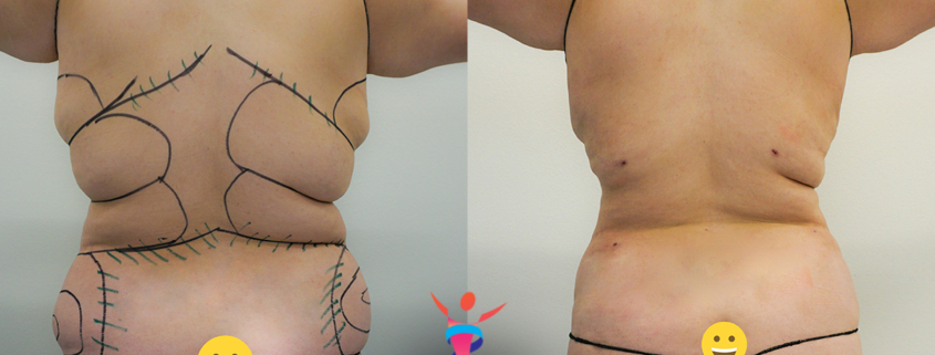 360 liposuction before & after