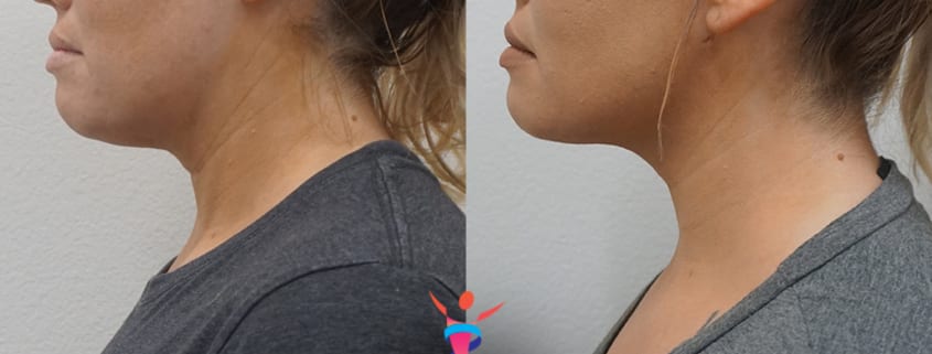 Chin Liposuction Before & After