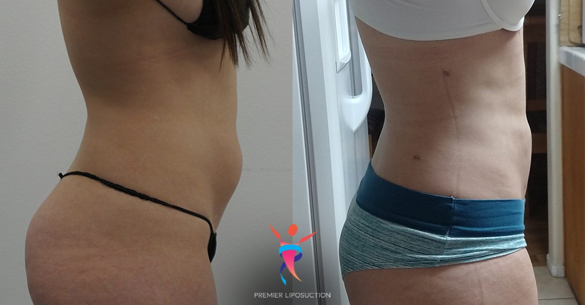 Lower abdomen liposuction before & after
