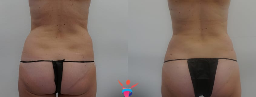 Lower back/hip rolls liposuction before & after
