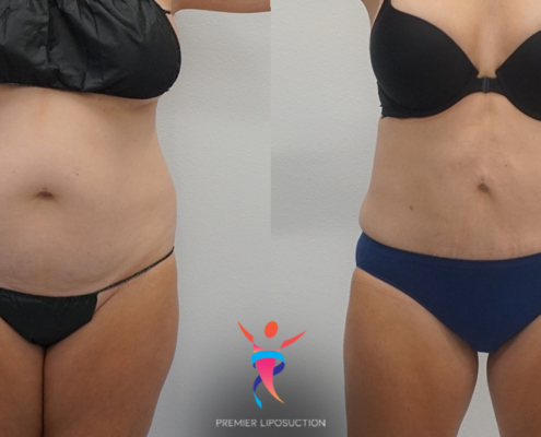 360 Liposuction before and after