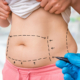 liposuction consultation