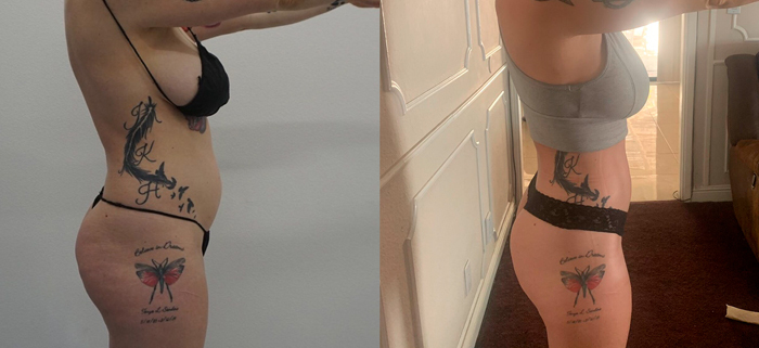 360 liposuction side view before & after