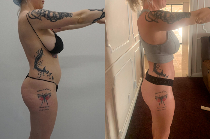 360 liposuction side view before & after