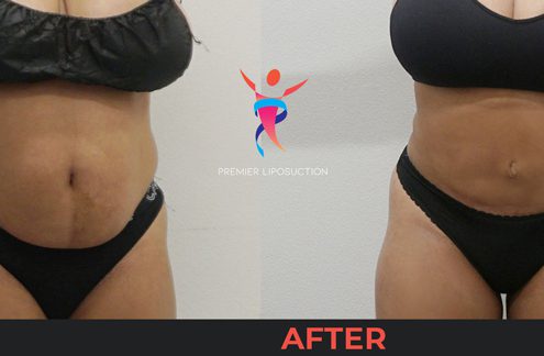 tummy tuck before and after liposuction