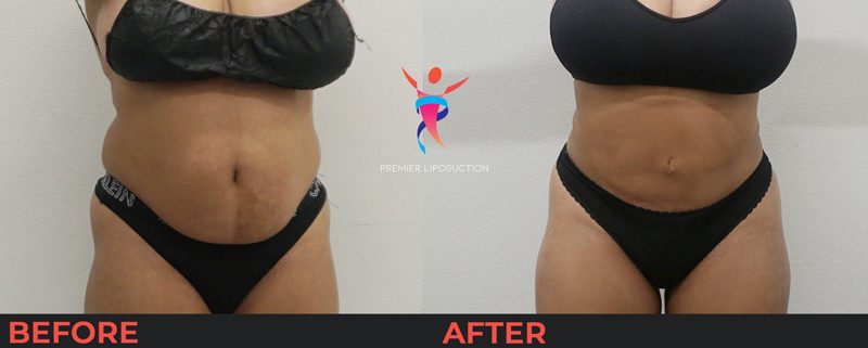 tummy tuck before and after liposuction