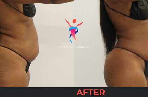 belly liposuction before and after