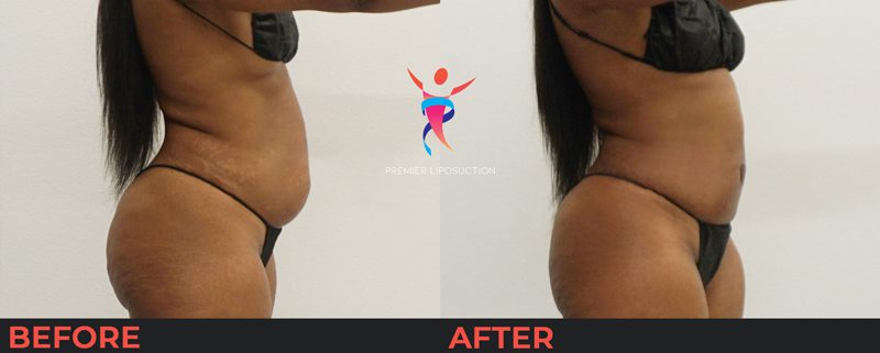 belly liposuction before and after