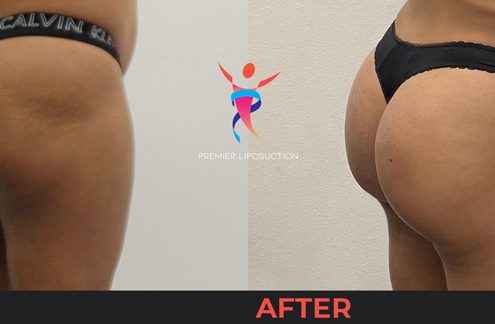 butt lift before and after