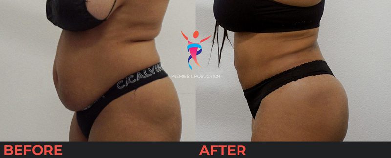 woman with stomach before and after liposuction