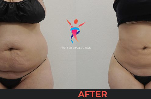 stomach liposuction before and after