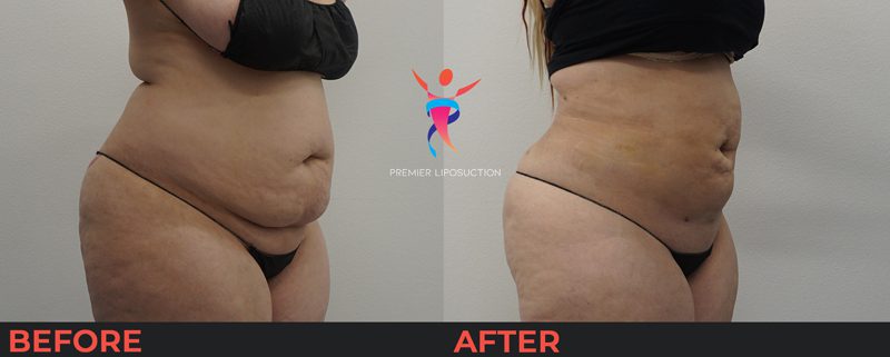 before and after image of woman with stomach liposuction