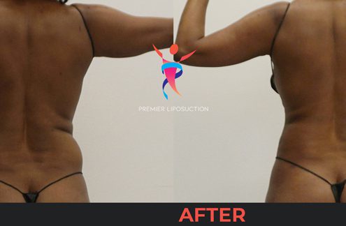 back and hip liposuction before and after