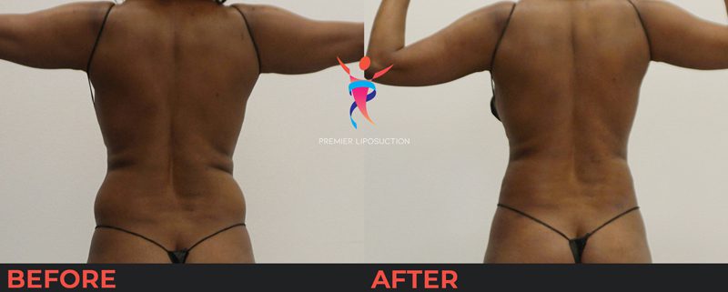 back and hip liposuction before and after
