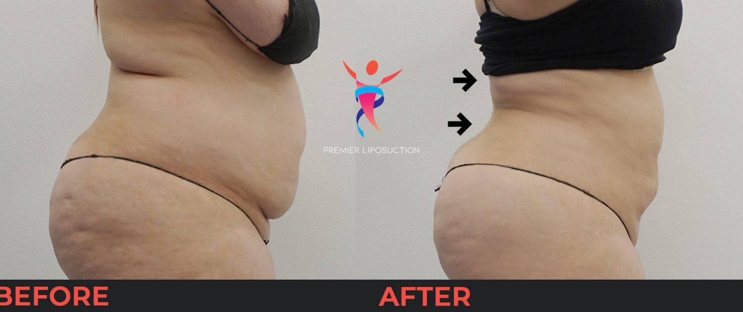 back liposuction before and after