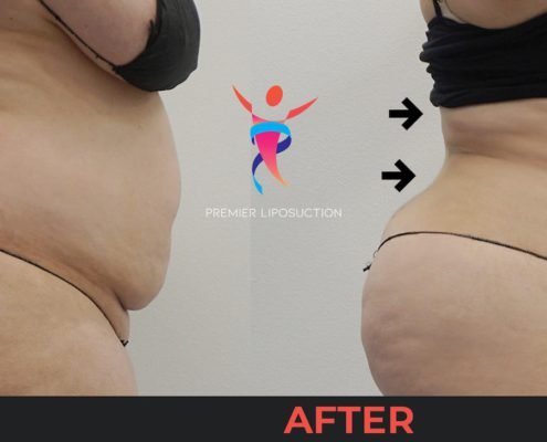 back liposuction before and after