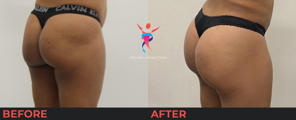 woman with butt lift before and after