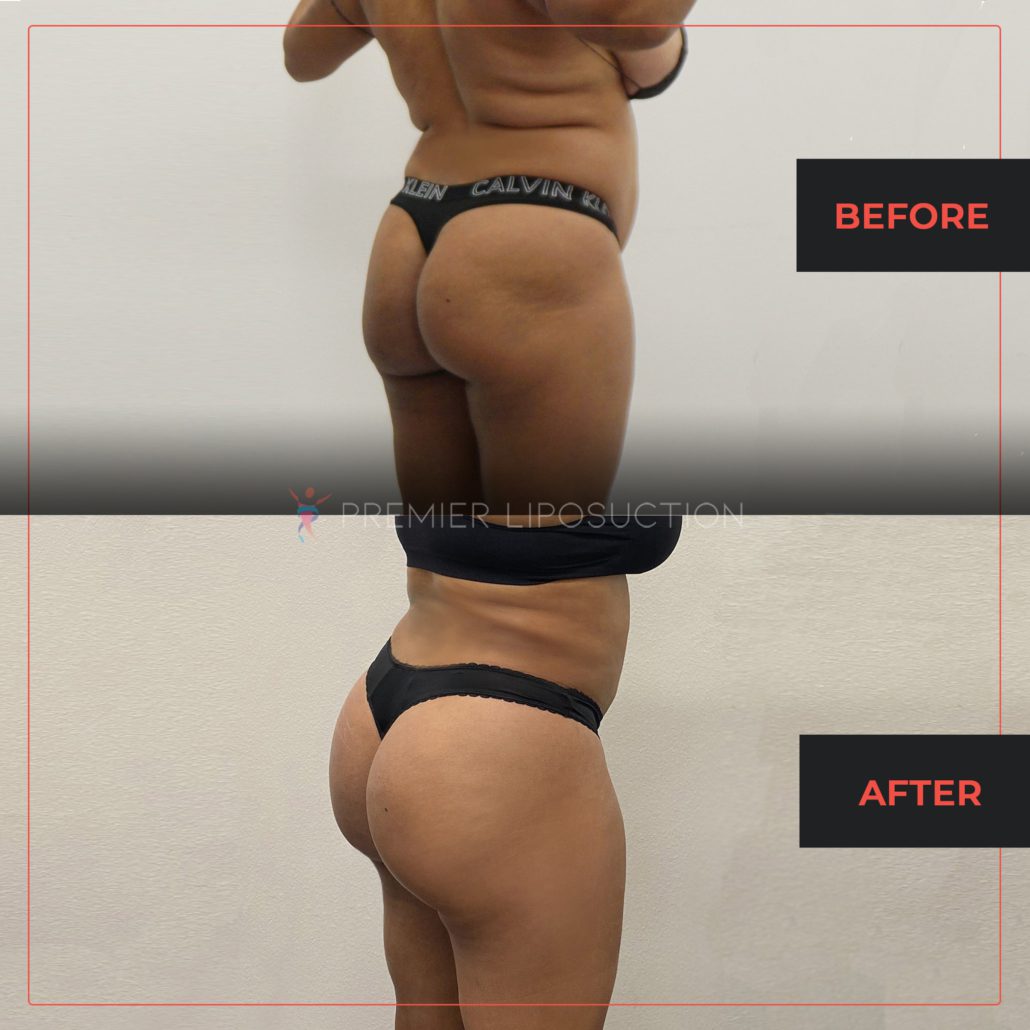 before and after woman's butt lift fat transfer