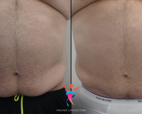 Pannus liposuction before and after